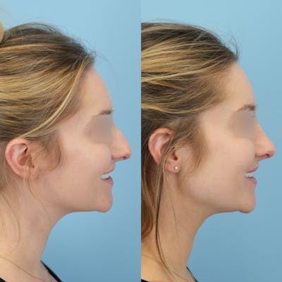 Rhinoplasty Before & After Gallery - Patient 191140 - Image 4