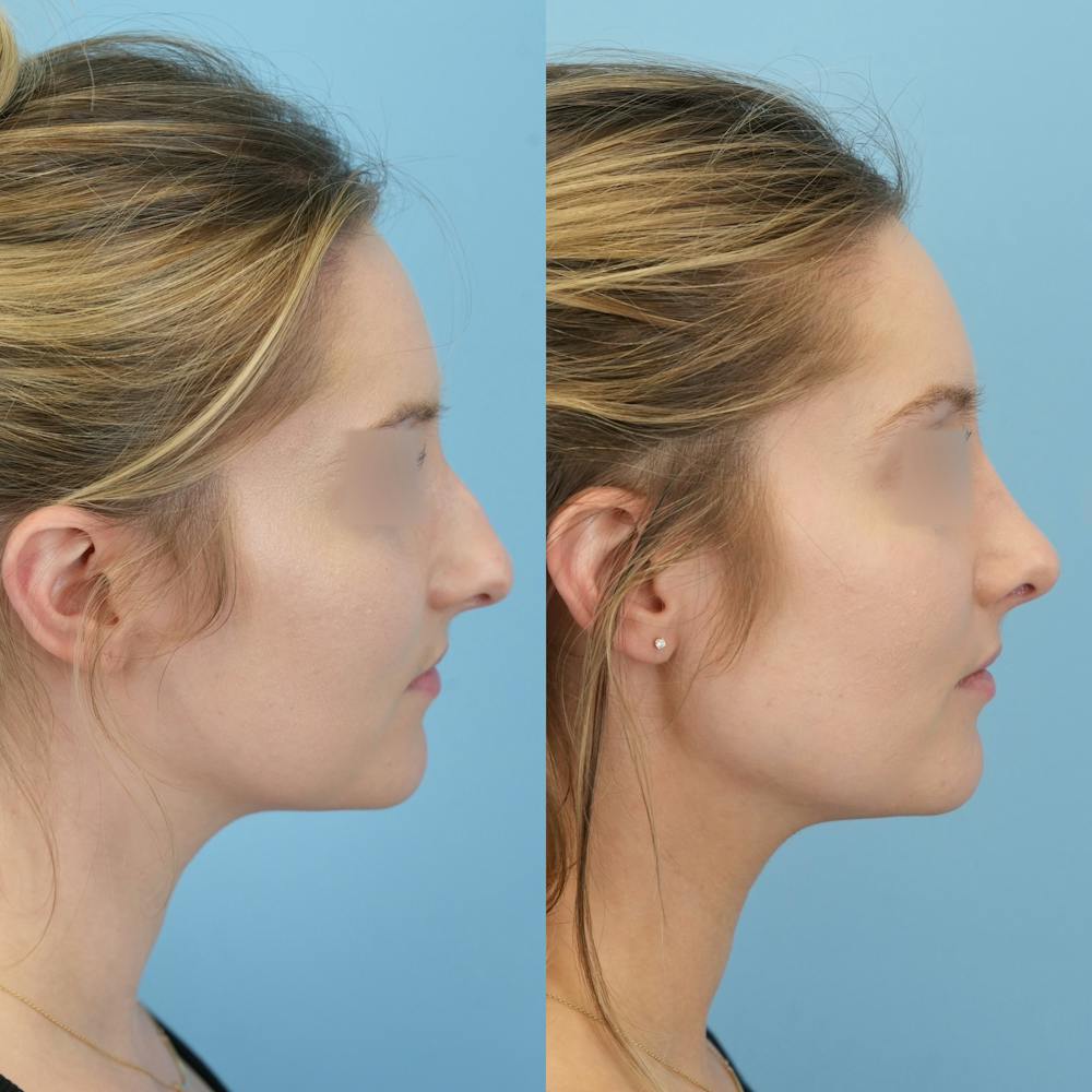 Rhinoplasty Before & After Gallery - Patient 191140 - Image 3