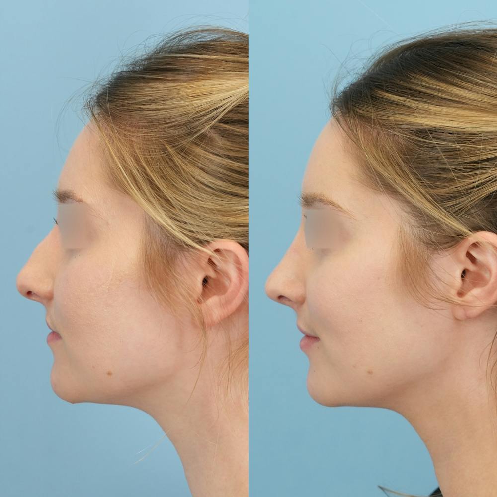 Rhinoplasty Before & After Gallery - Patient 191140 - Image 6