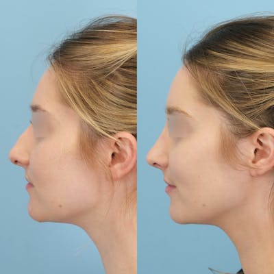 Rhinoplasty Before & After Gallery - Patient 191140 - Image 6