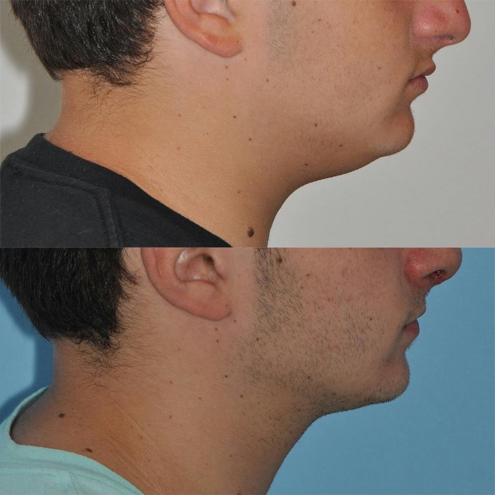 Neck Liposuction Before & After Gallery - Patient 31709173 - Image 2