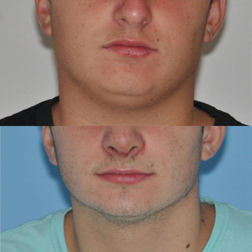 Neck Liposuction Before & After Gallery - Patient 31709173 - Image 3