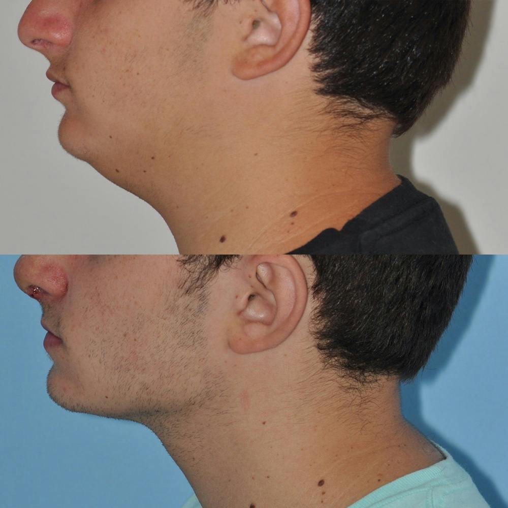 Neck Liposuction Before & After Gallery - Patient 31709173 - Image 1