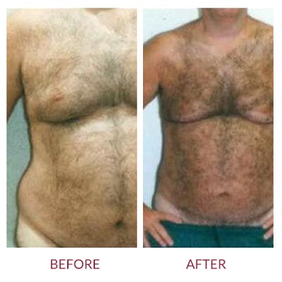 Liposuction Before & After Gallery - Patient 26868609 - Image 1
