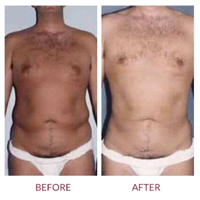 Liposuction Before & After Gallery - Patient 26868644 - Image 1