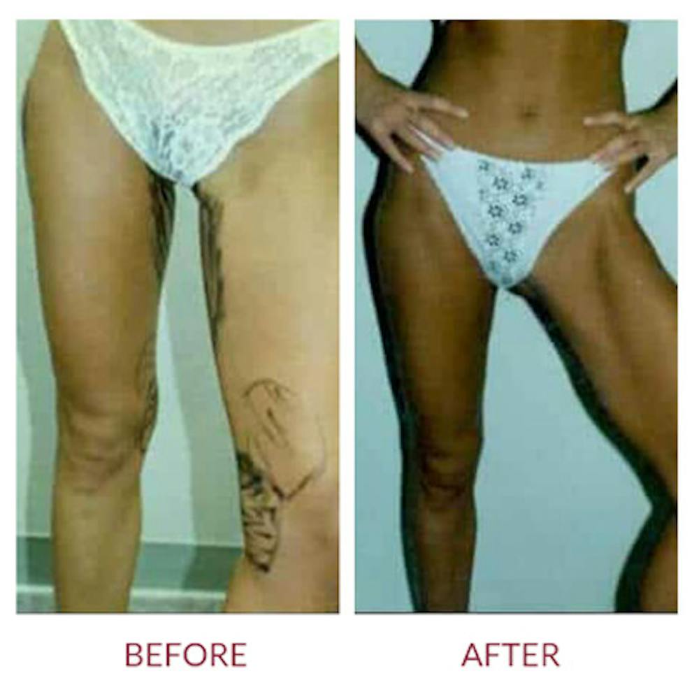 Liposuction Gallery - Patient 26868643 - Image 1