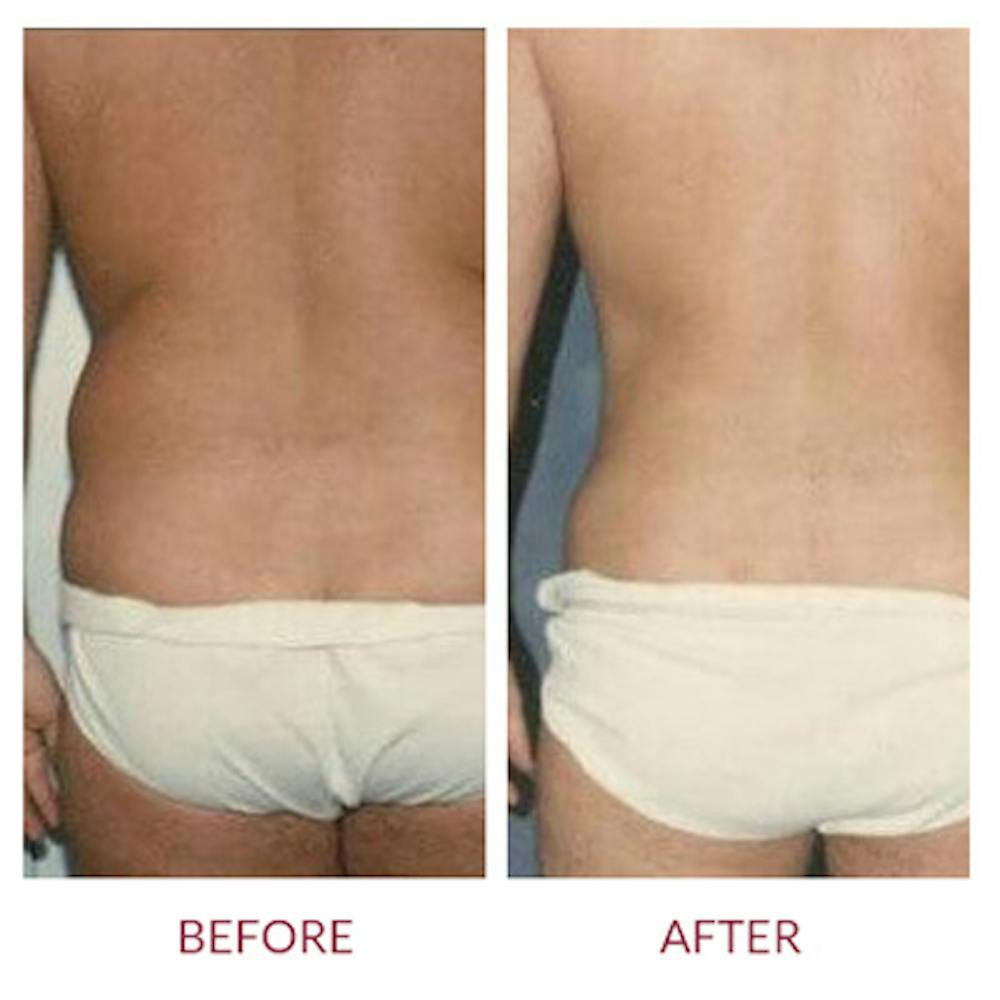 Liposuction