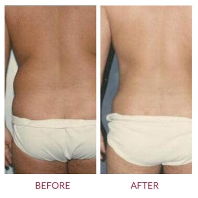 Liposuction Before & After Gallery - Patient 26868642 - Image 1