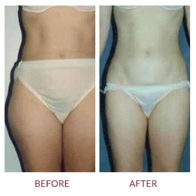 Liposuction Before & After Gallery - Patient 26868641 - Image 1