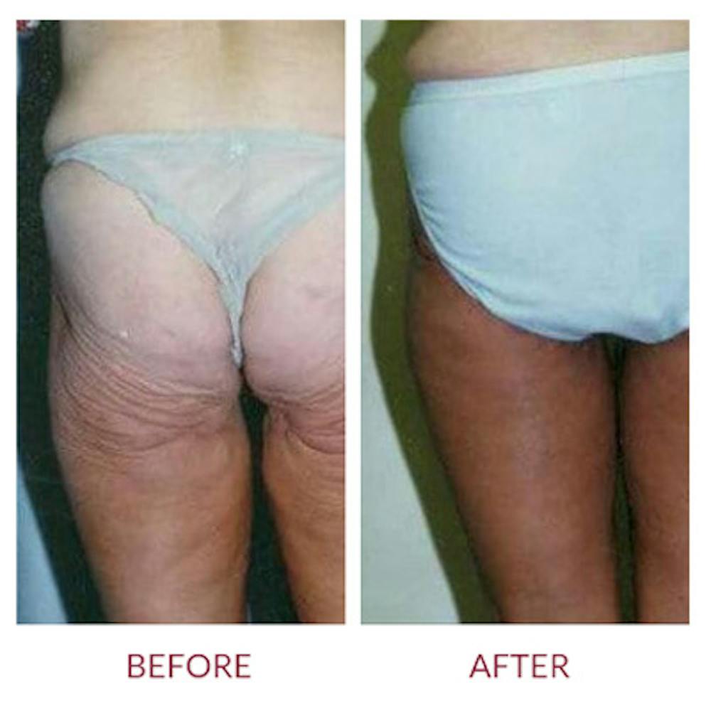 Thigh Lift Before & After Gallery - Patient 26868646 - Image 1