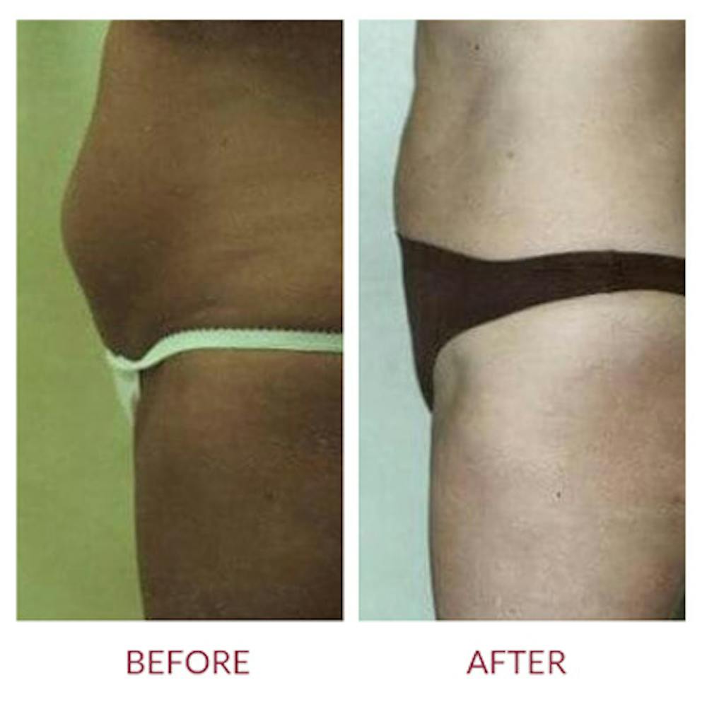 Tummy Tuck Before & After Gallery - Patient 26868664 - Image 1