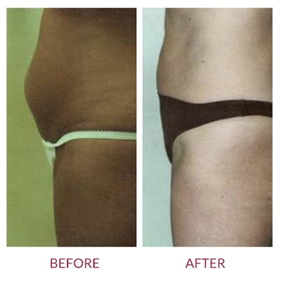 Tummy Tuck Before & After Gallery - Patient 26868664 - Image 1