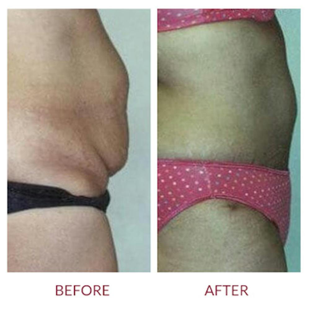 Tummy Tuck Before & After Gallery - Patient 26868663 - Image 1