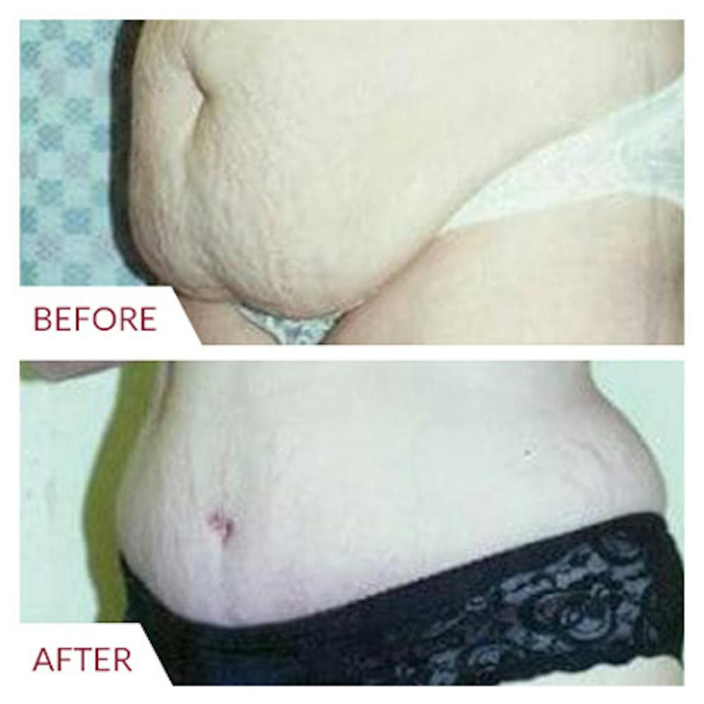 Tummy Tuck Before & After Gallery - Patient 26868662 - Image 1