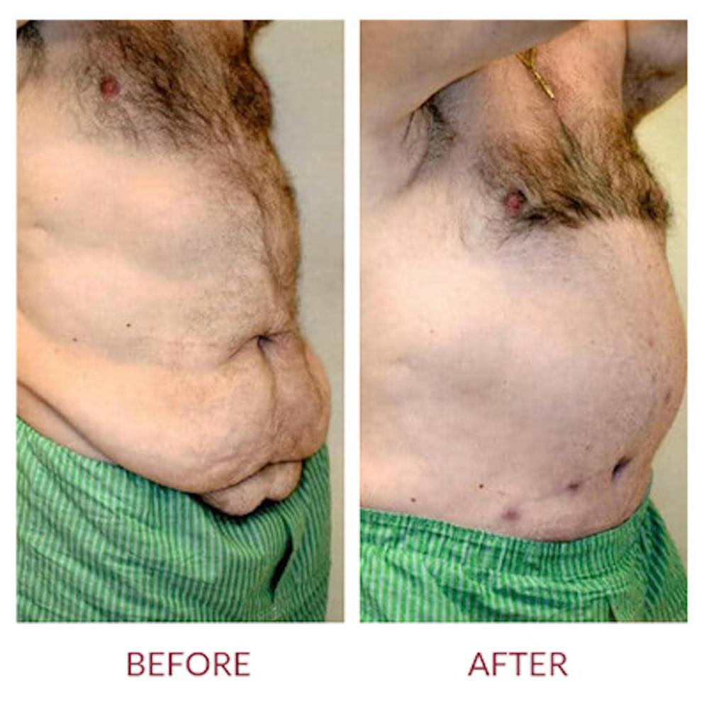 Tummy Tuck Before & After Gallery - Patient 26868661 - Image 6