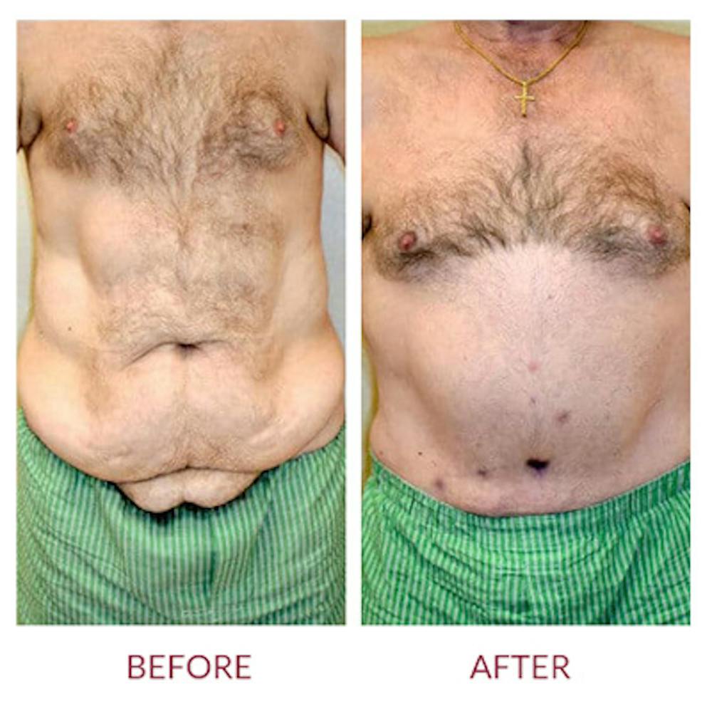 Tummy Tuck Before & After Gallery - Patient 26868661 - Image 5