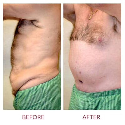 Tummy Tuck Before & After Gallery - Patient 26868661 - Image 4