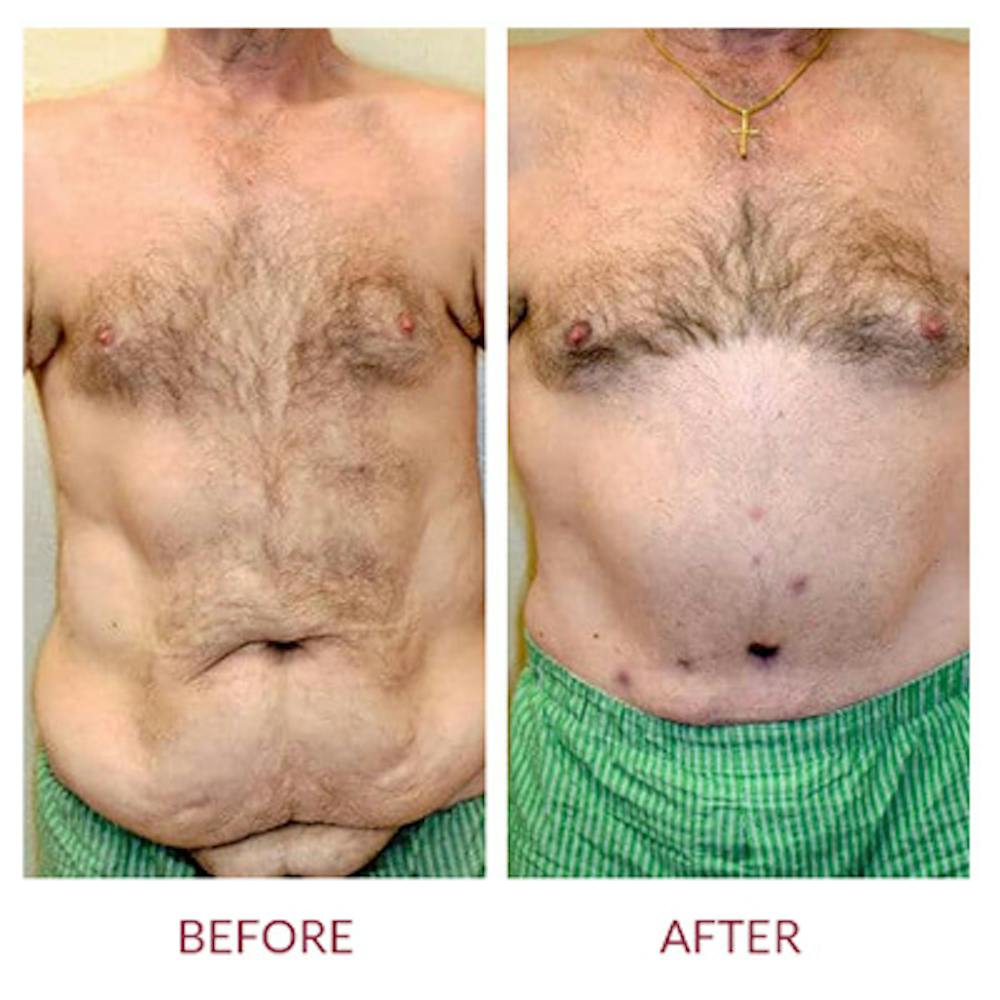 Tummy Tuck Before & After Gallery - Patient 26868661 - Image 3
