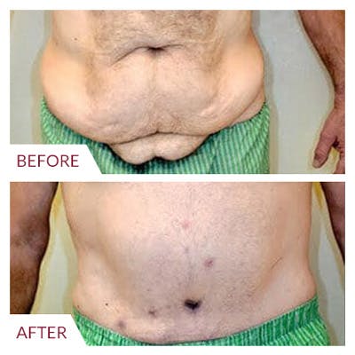 Tummy Tuck Before & After Gallery - Patient 26868661 - Image 2