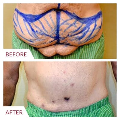 Tummy Tuck Before & After Gallery - Patient 26868661 - Image 1
