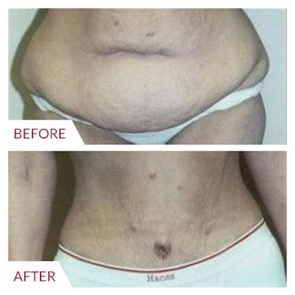 Tummy Tuck Before & After Gallery - Patient 26868660 - Image 1