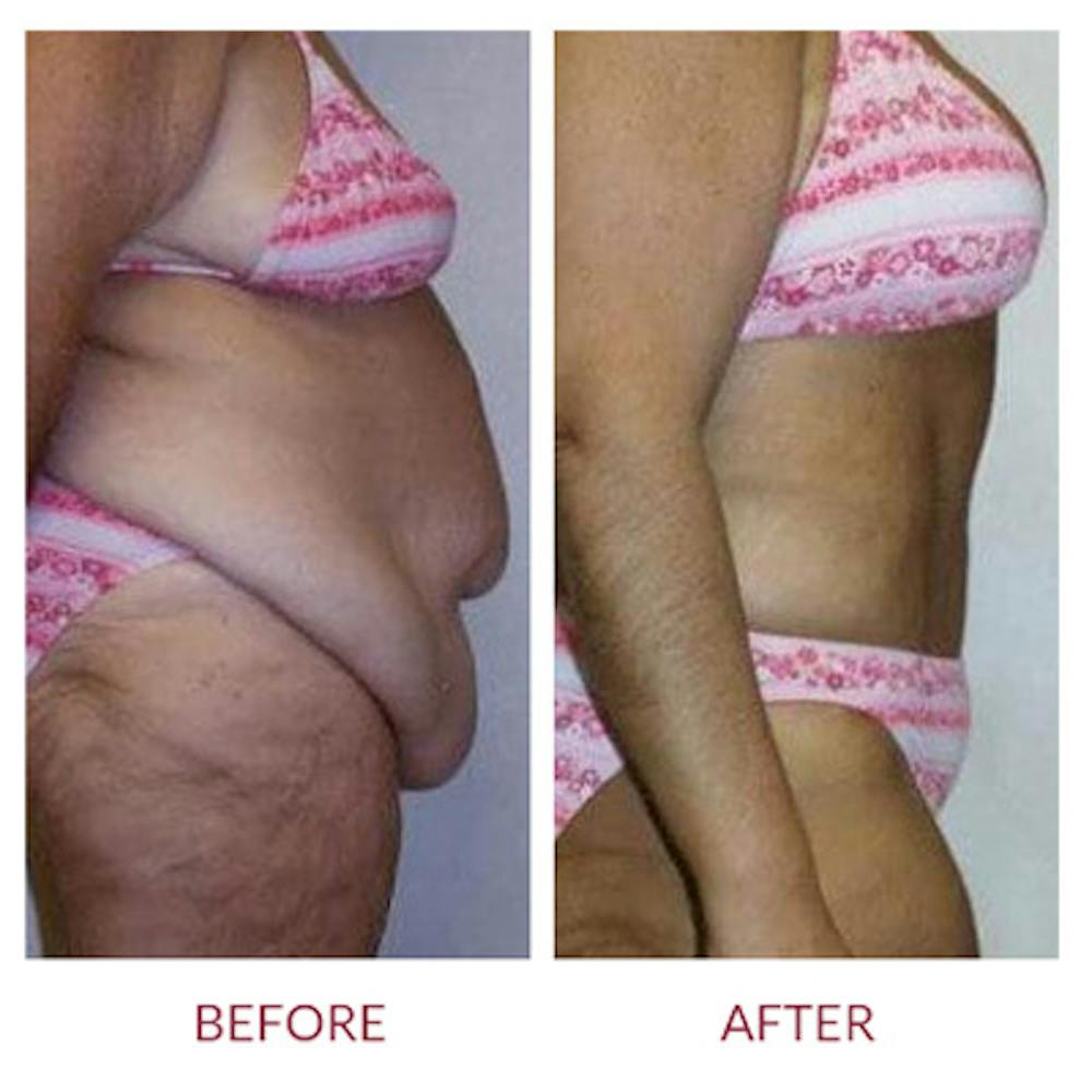 Tummy Tuck Before & After Gallery - Patient 26868659 - Image 2