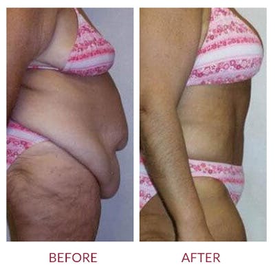 Tummy Tuck Before & After Gallery - Patient 26868659 - Image 2