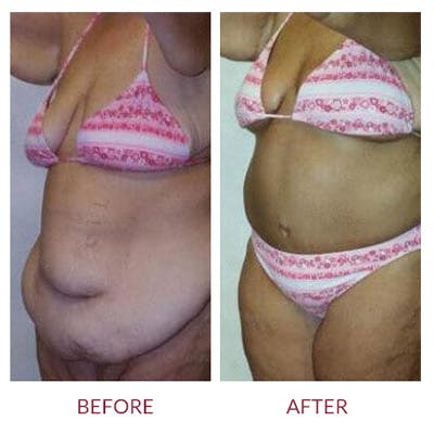 Tummy Tuck Before & After Gallery - Patient 26868659 - Image 1