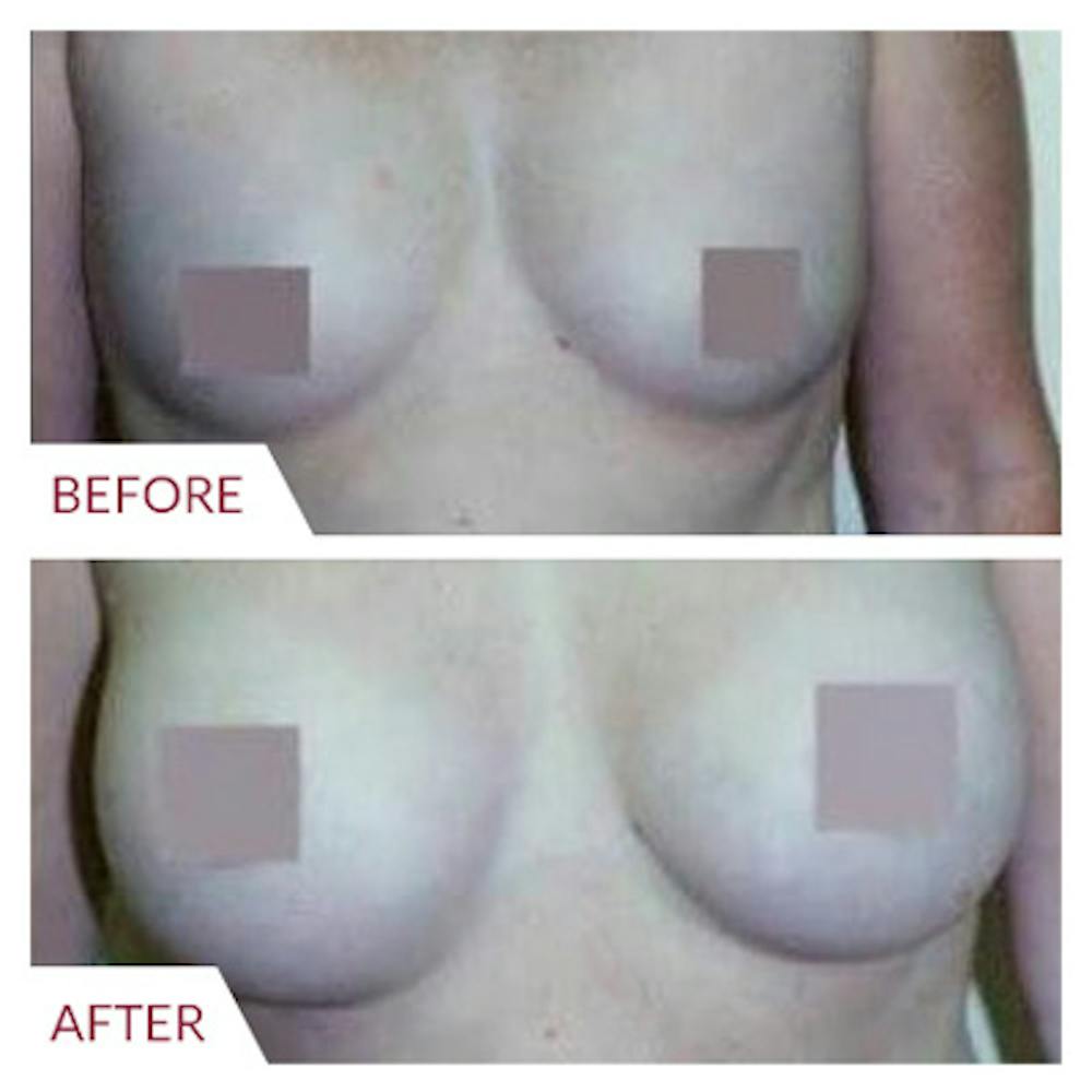 Breast Augmentation Before & After Gallery - Patient 26868726 - Image 1
