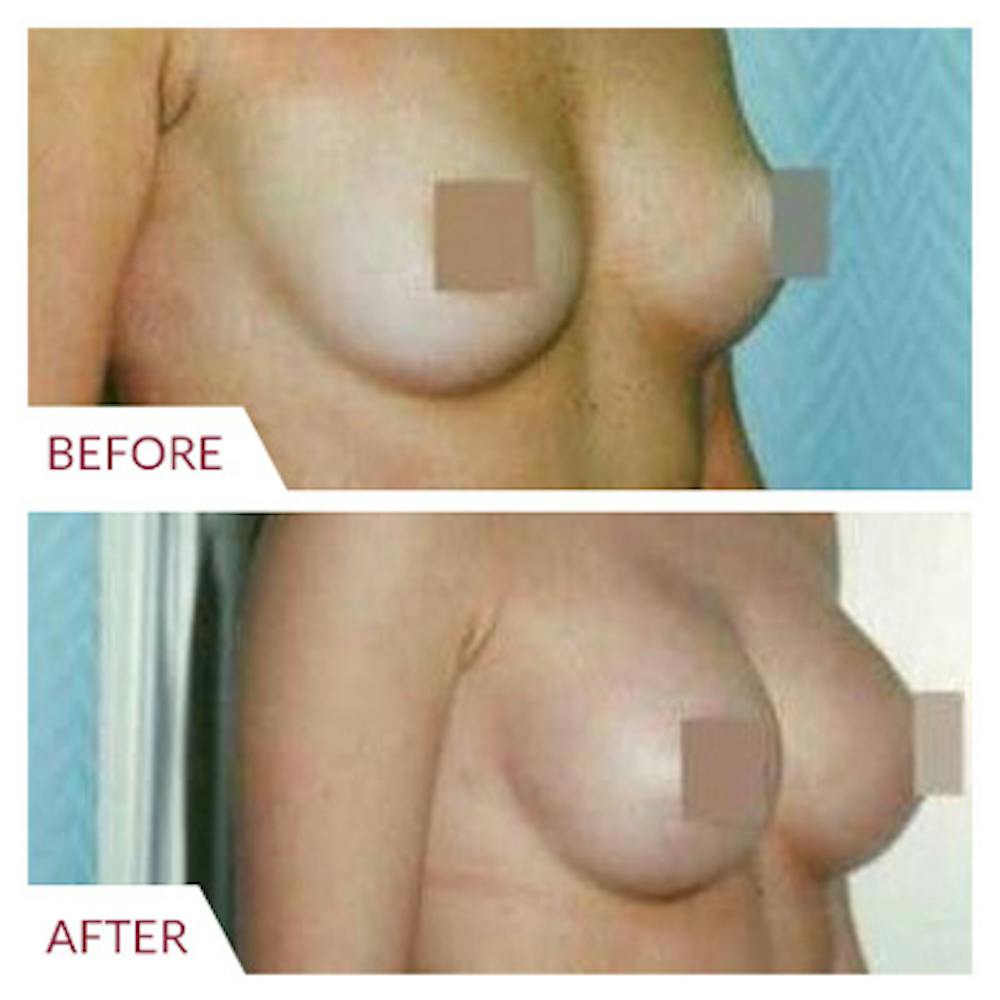 Breast Augmentation Before & After Gallery - Patient 26868725 - Image 1