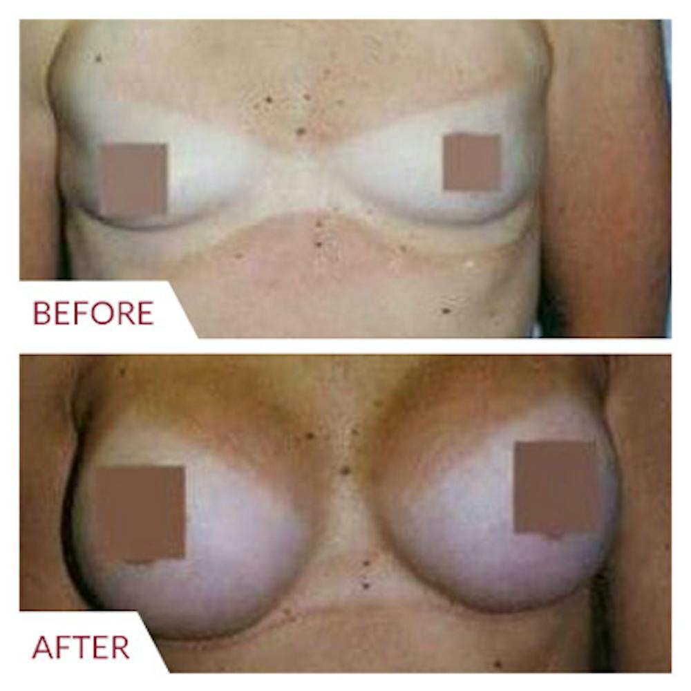 Breast Augmentation Before & After Gallery - Patient 26868724 - Image 1