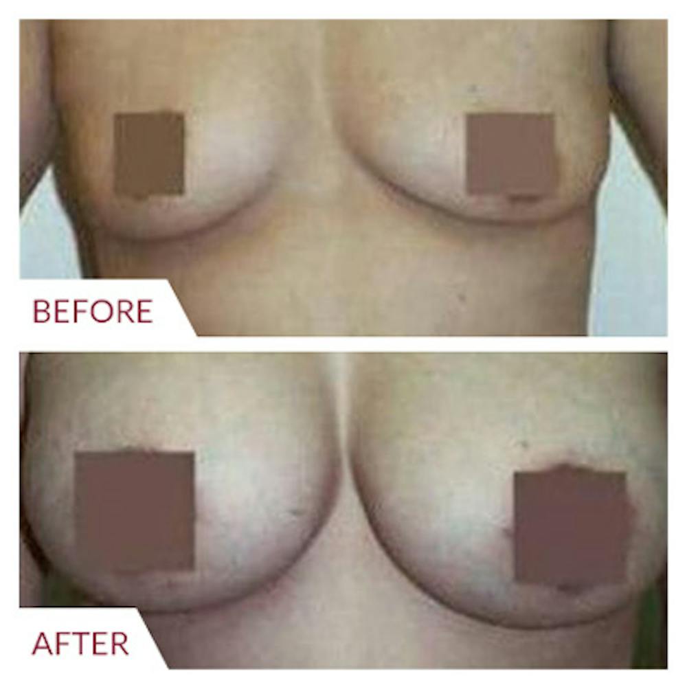 Breast Augmentation
