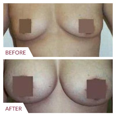 Breast Augmentation Before & After Gallery - Patient 26868722 - Image 1