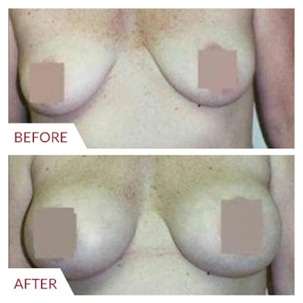 Breast Augmentation