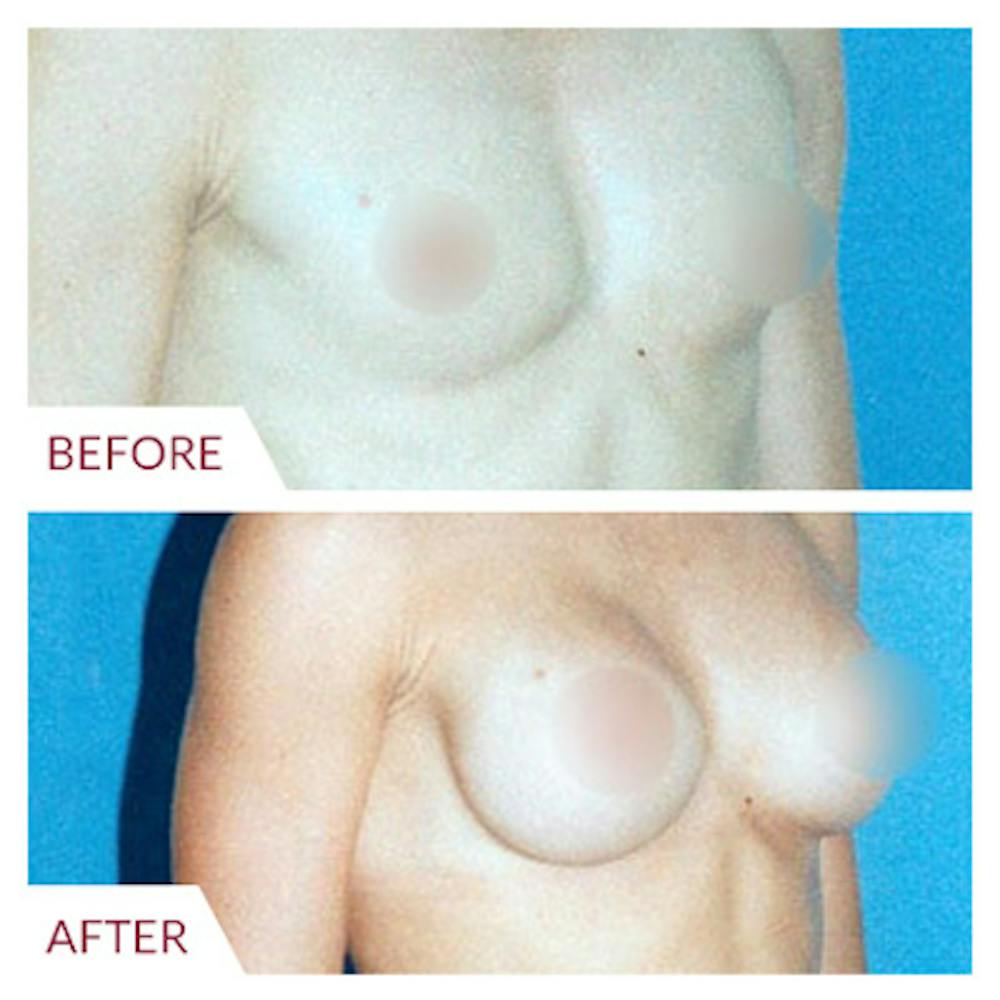 Breast Augmentation