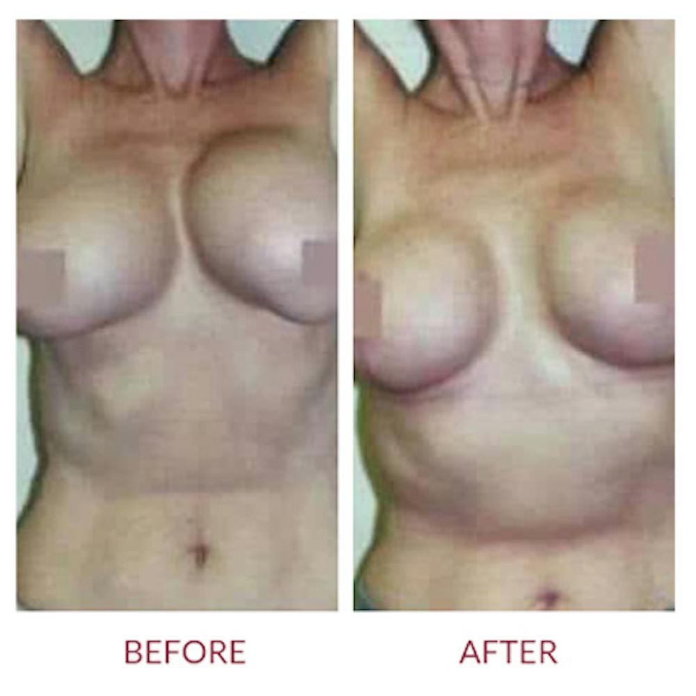 Breast Correction Before & After Gallery - Patient 26868734 - Image 1