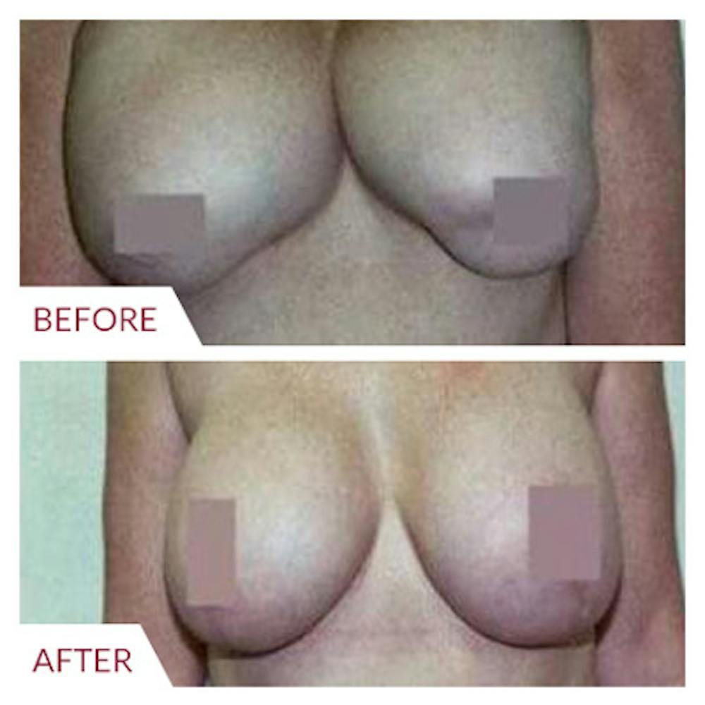Breast Correction Before & After Gallery - Patient 26868733 - Image 1