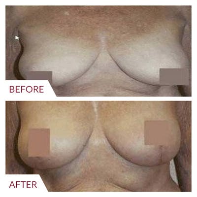 Breast Lift Before & After Gallery - Patient 26868750 - Image 1
