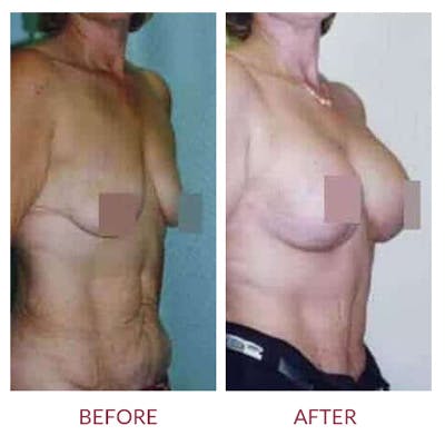 Breast Lift Gallery - Patient 26868749 - Image 1
