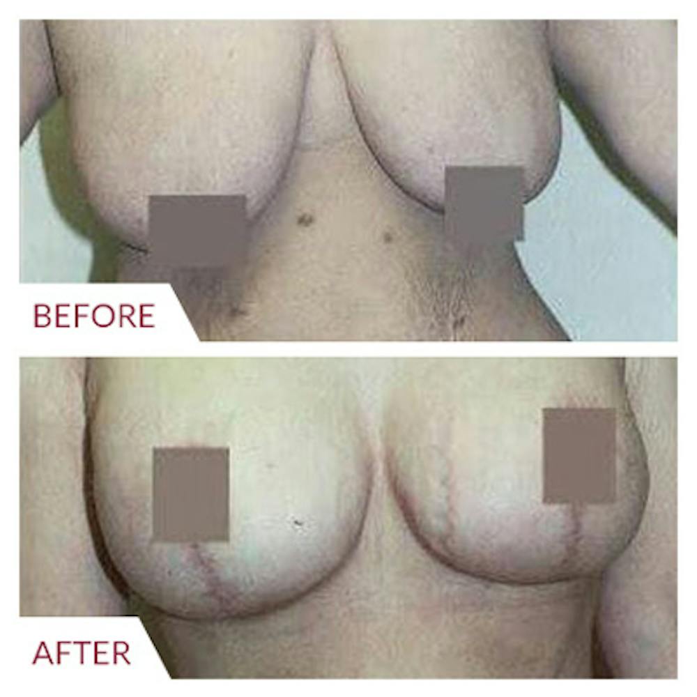 Breast Lift
