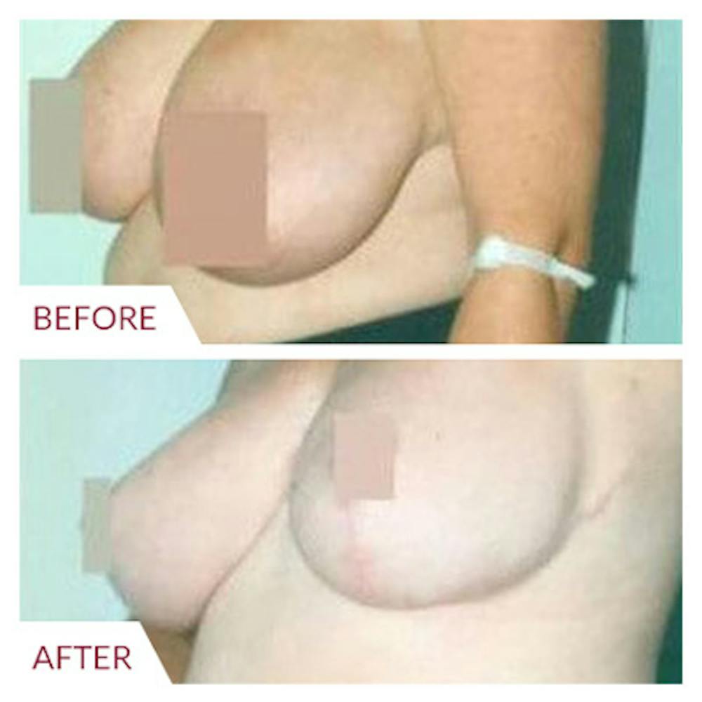 Breast Reduction Gallery - Patient 26868761 - Image 2