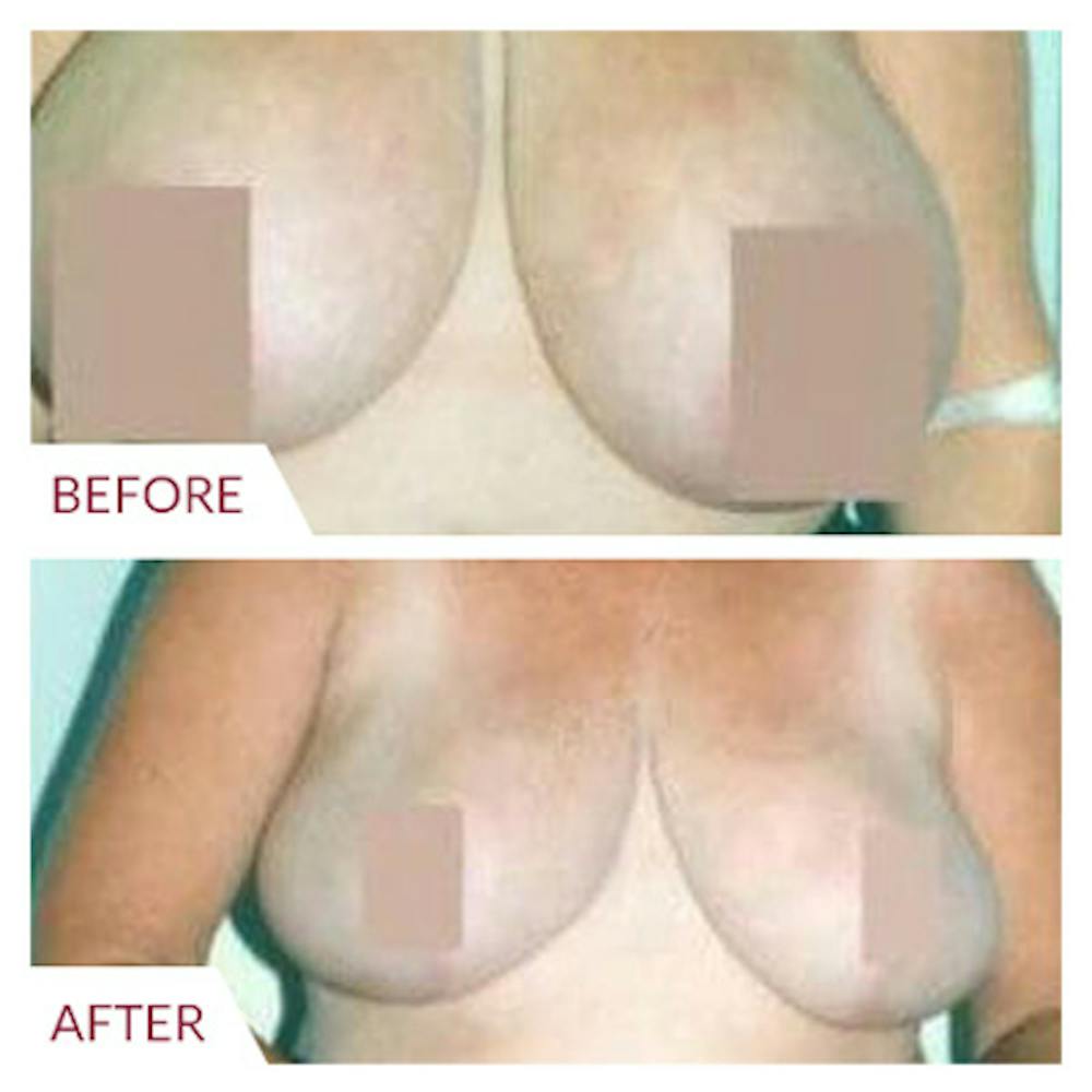 Breast Reduction Before & After Gallery - Patient 26868761 - Image 1