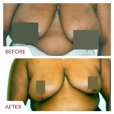 Breast Reduction Gallery - Patient 26868760 - Image 1