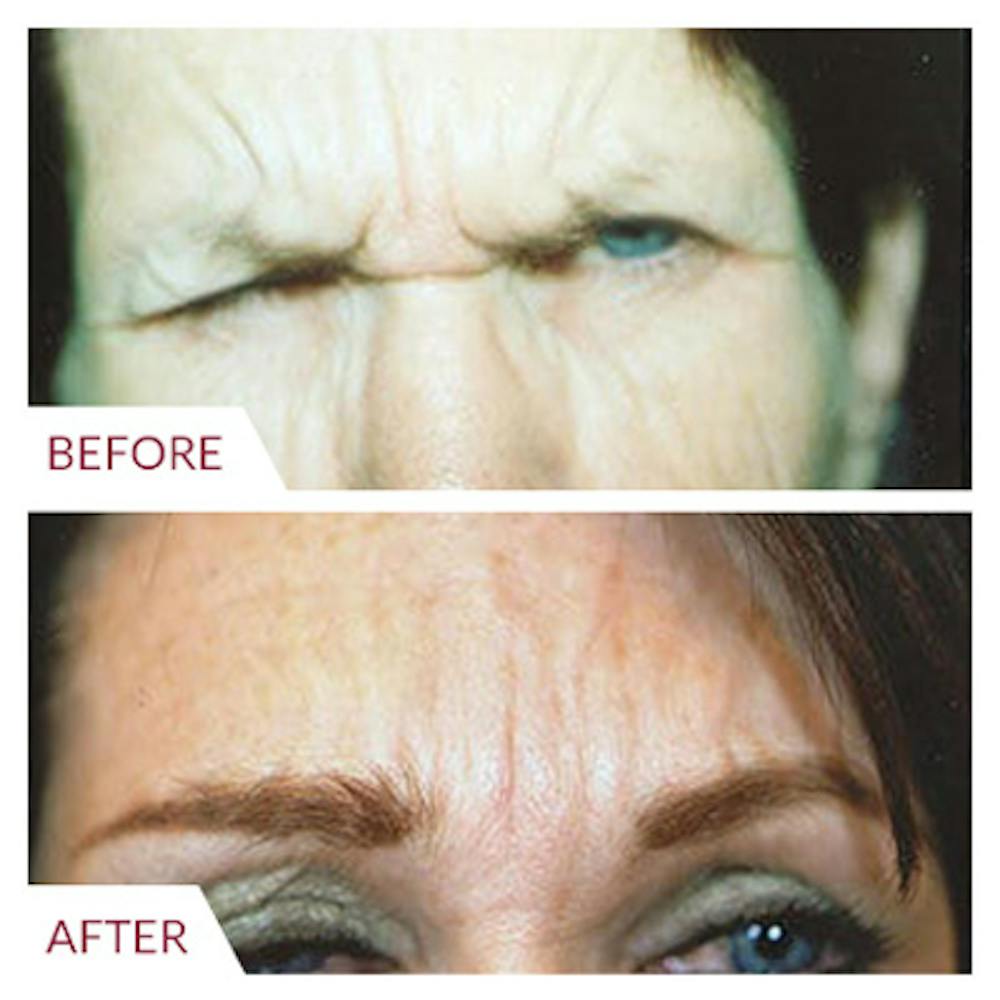 Brow Lift