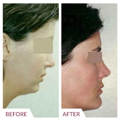 Chin Augmentation Before & After Gallery - Patient 26868788 - Image 1