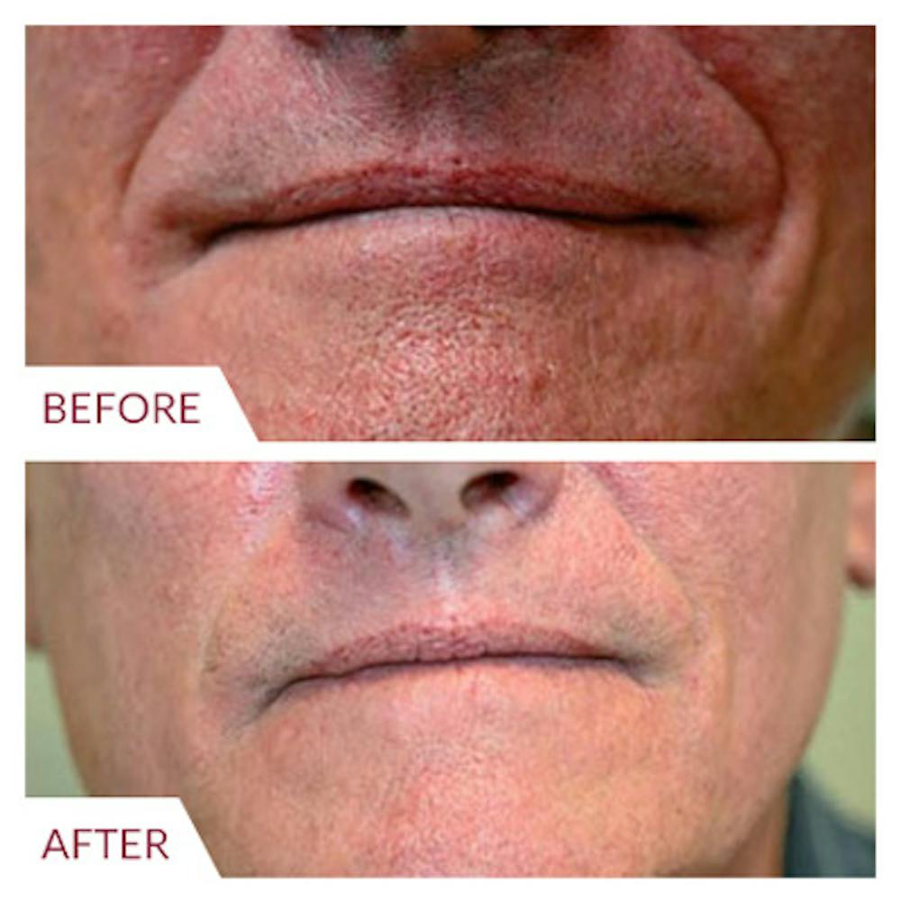 Co2 Laser Resurfacing Before & After Gallery - Patient 26868808 - Image 6