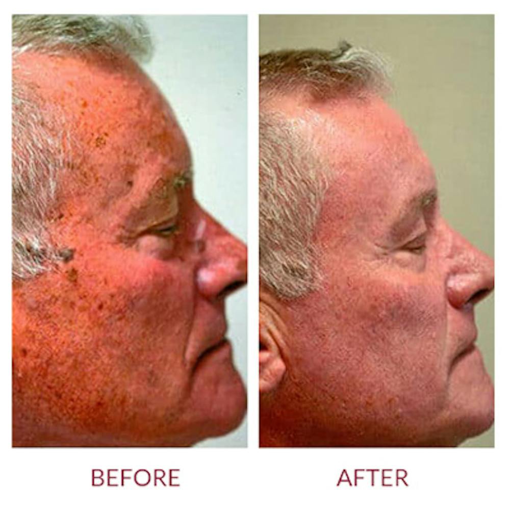 Co2 Laser Resurfacing Before & After Gallery - Patient 26868808 - Image 5