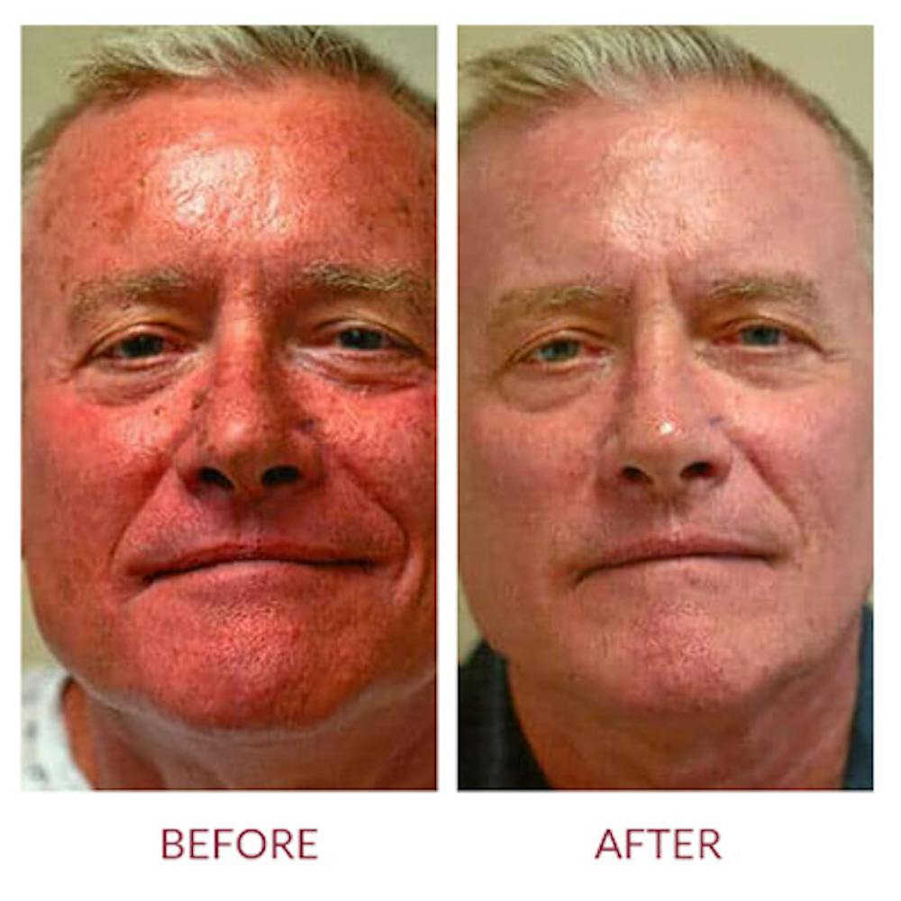 Co2 Laser Resurfacing Before & After Gallery - Patient 26868808 - Image 4