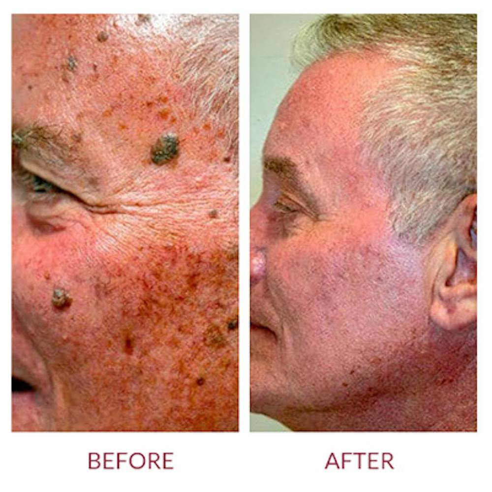 Co2 Laser Resurfacing Before & After Gallery - Patient 26868808 - Image 3