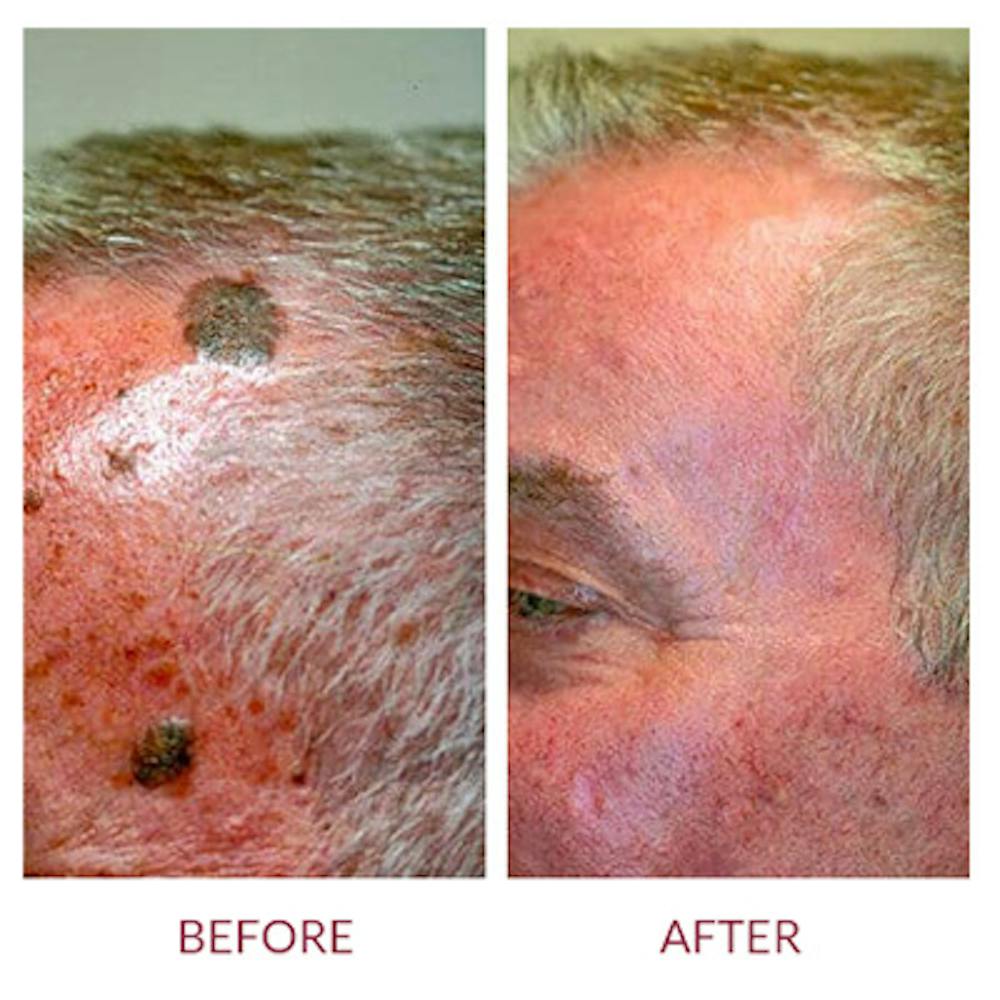 Co2 Laser Resurfacing Before & After Gallery - Patient 26868808 - Image 2